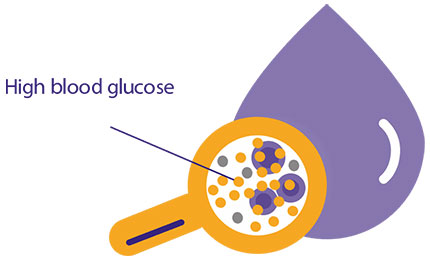 Diagram indicating high blood glucose within a drop of blood under a magnifying glass